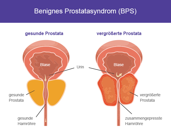 Cialis Bei Prostatabeschwerden Versand Apotheke Deutschland 